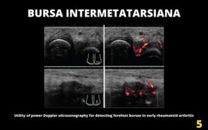 Bursitis intermetatarsiana
