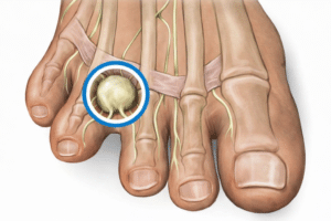 Neuroma de Morton solucion
