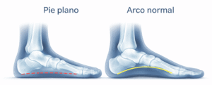 pie plano pie con arco normal