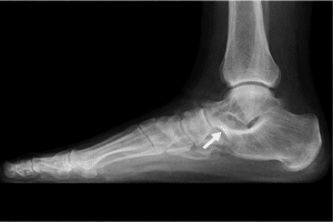 pie plano rígido por coalición tarsal