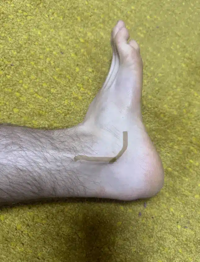 Localización de la tendinopatía de peroneos