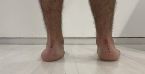 Pie con valgo de talón