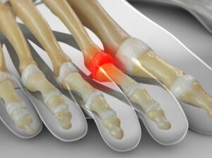 Capsulitis metatarsalgia