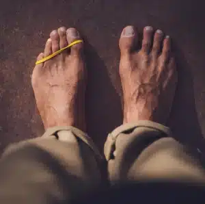 Pie apretado por calzado estrecho, causa del Neuroma de Morton