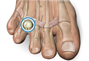Neuroma de Morton podólogo en Santiago