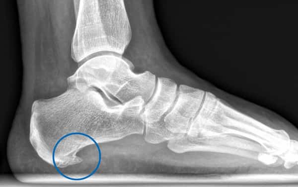 Imagen de una fascitis plantar